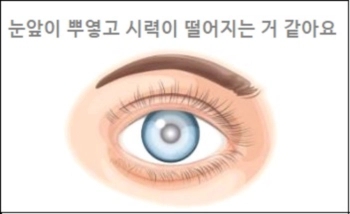  눈앞이 뿌옇고 시력이 떨어지는 거 같아요.