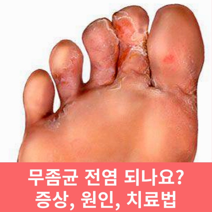  무좀 종류 증상, 원인, 치료 / 무좀균 전염되나요?