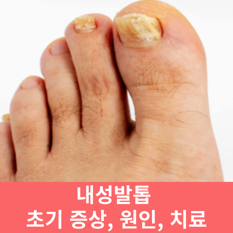  파고드는 내성발톱 초기 증상 원인 치료