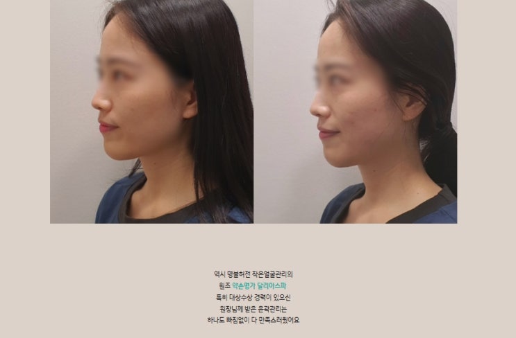  서면 윤곽관리 작은얼굴은 달리아스파(by.떵헤)