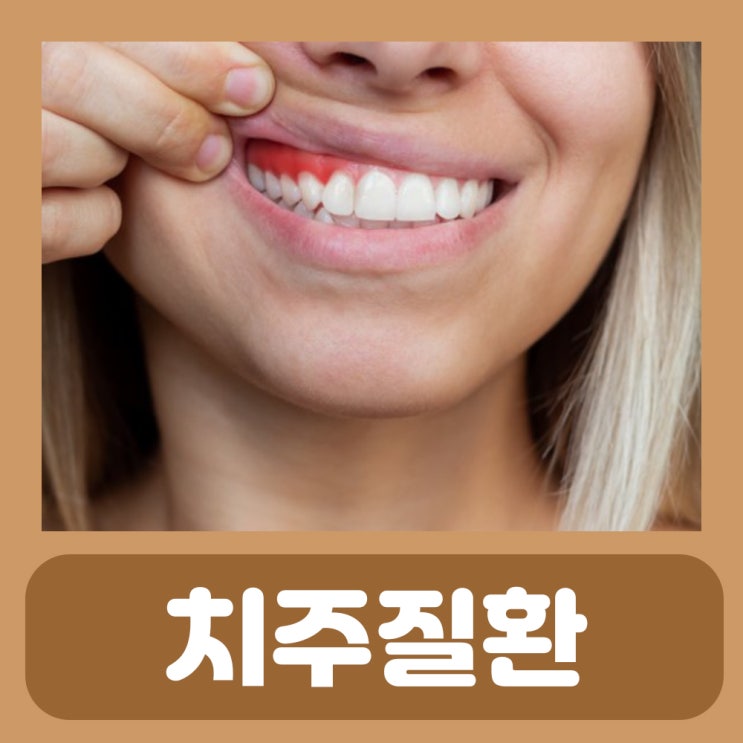  풍치 뜻 증상 원인 치료법 치주질환 잇몸 염증 출혈 아플때 부었을때