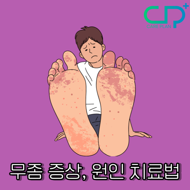 무좀 증상, 원인 치료법