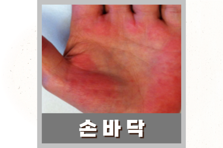  손바닥이 빨개요 빨갛게 변하는 이유와 대처 방법