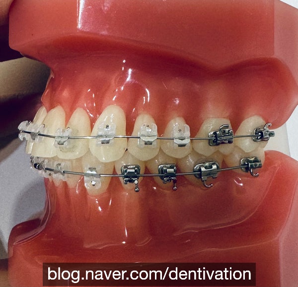  인비절라인, 데이먼, 클리피씨 브라켓 비교 - Invisalign, Damon, Clippy-C 모형 사진