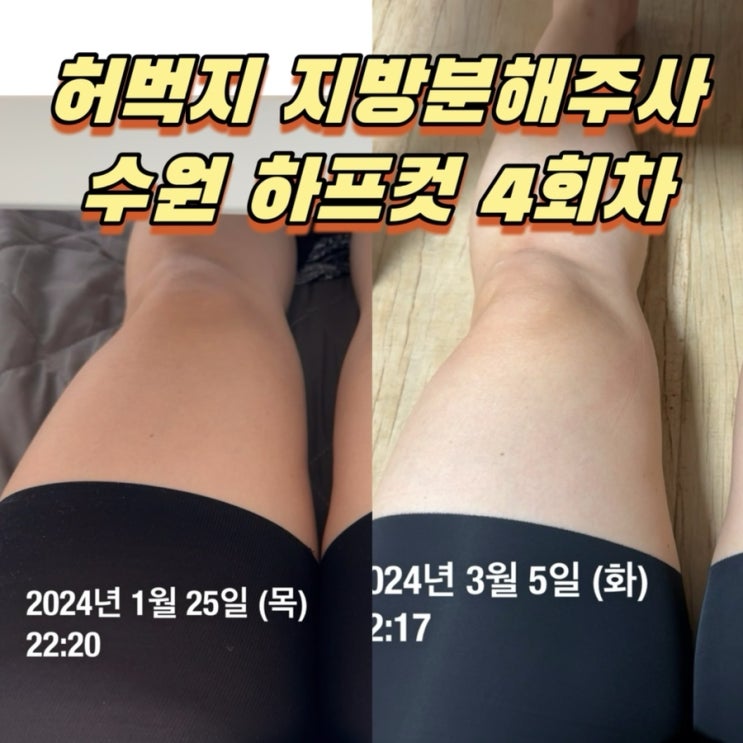  수원 다이어트! 특허받은 허벅지 지방분해주사 하프컷 4회차 후기