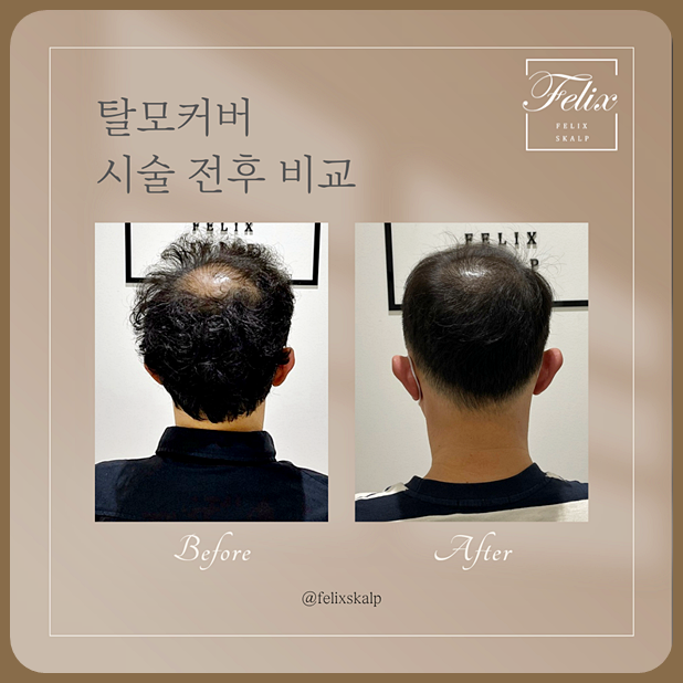  사우동탈모커버 걸포동두피커버 확실한방법!필릭스스칼프에서 탈모 스트레스 한방에 해결하세요