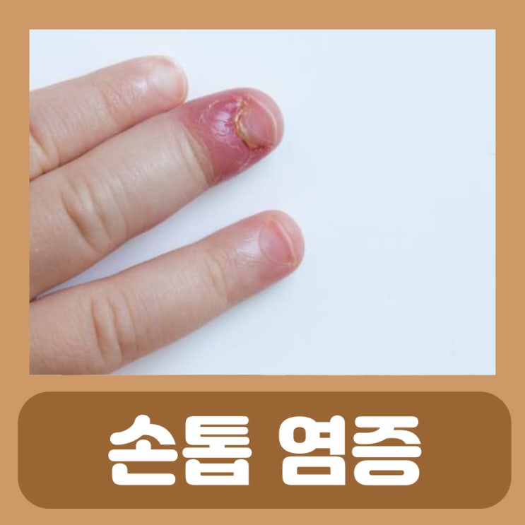 생인손 치료 조갑주위염 생손앓이 손톱 염증 고름 변형 빠짐 갈라짐 찢어짐 울퉁불퉁