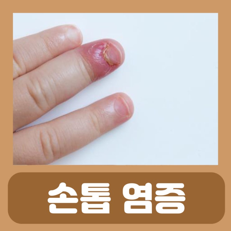  생인손 치료 조갑주위염 생손앓이 손톱 염증 고름 변형 빠짐 갈라짐 찢어짐 울퉁불퉁