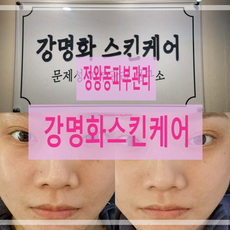  정왕동피부관리 잘하는 곳 강명화스킨케어 세멘부스팅먼트 후기