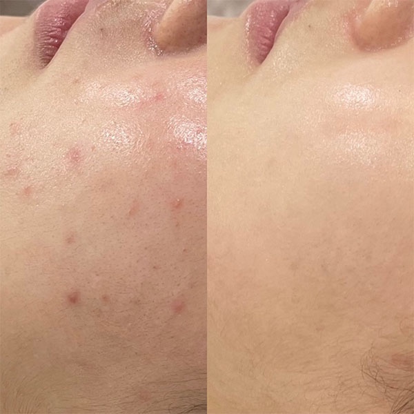  서초 여드름 압출 케어관리,지옥같은 피부트러블 극복 방배카페거리 피부샵 제리라이크에서