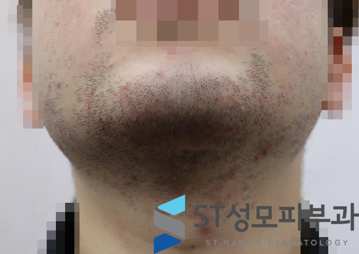  [남자 수염제모] 원리, 효과, 부작용, 통증, 몇 번 해야 할까 - 삼성동 피부과전문의 닥터림
