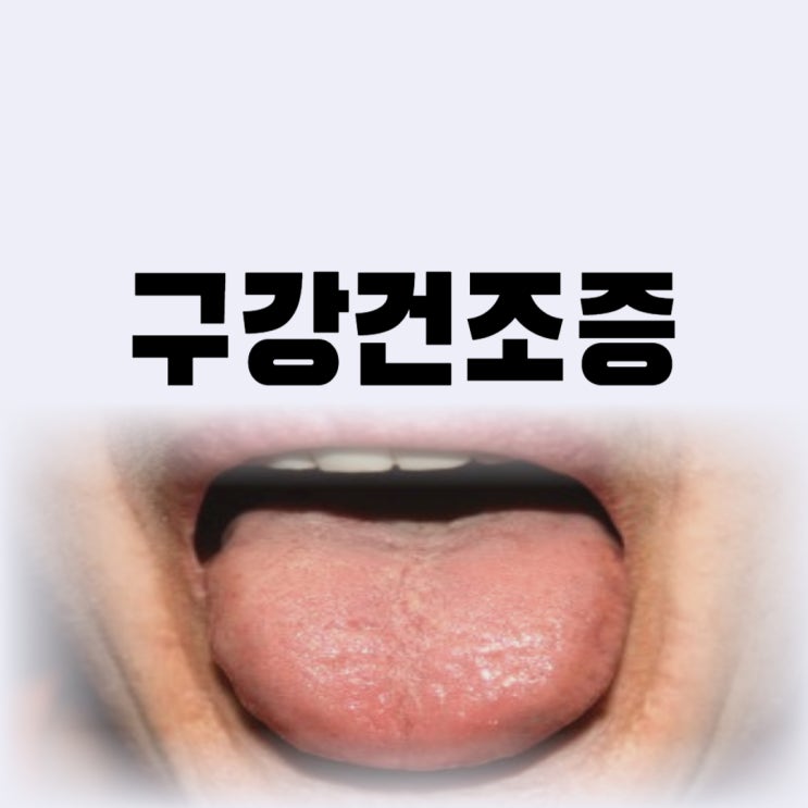  입안이 마르는 이유 입안 마름 원인 증상 구강건조증 때문이라면