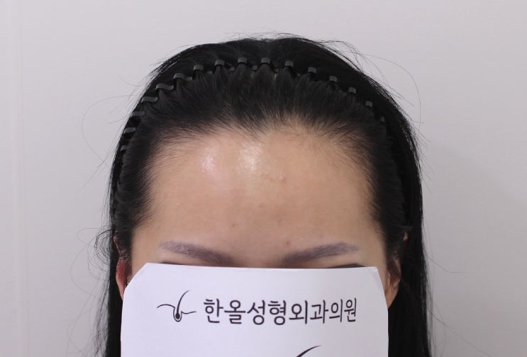  20대 여성 헤어라인 비절개 3500모 2주 경과