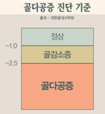  골다공증(Osteoporosis) 진단 기준표  ... -2.5보다 낮으면 골다공증   ... -1 보다 높으면 정상