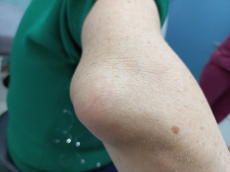  팔꿈치가 부어올랐어요.                                                 주두 점액낭염(Olecranon Bursitis)