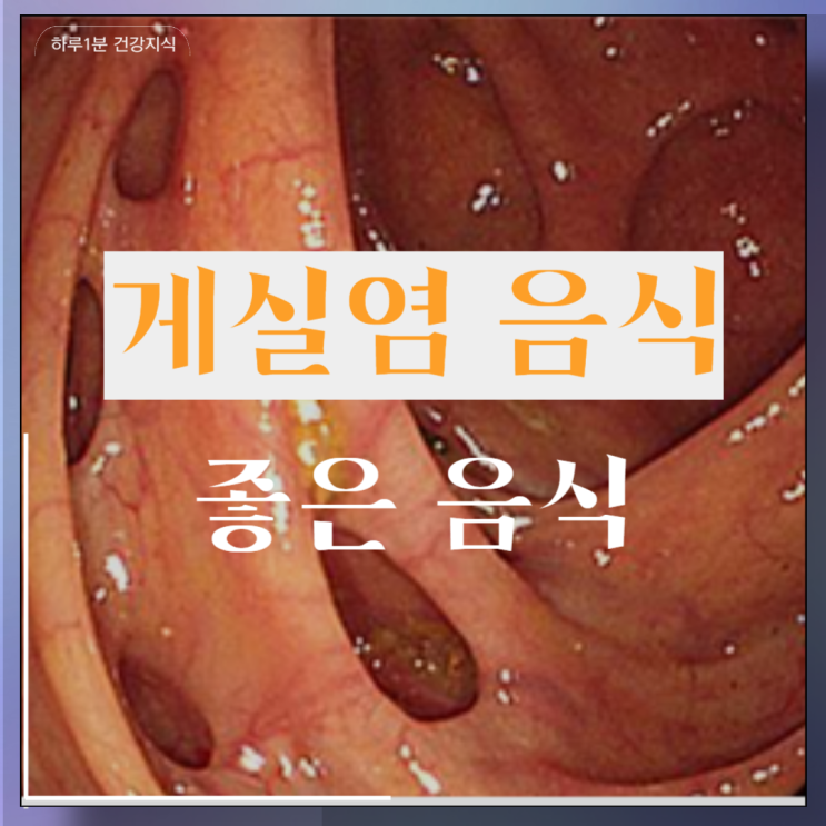  게실염에 좋은 음식 게실증 음식