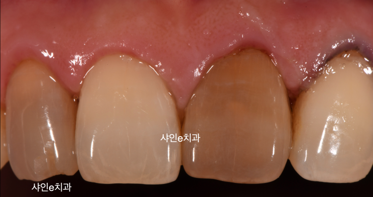  치아 변색! 비용이 걱정된다면 클릭하세요.