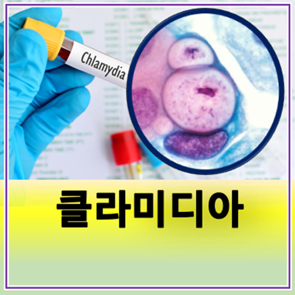 클라미디아 여자 남자 증상 자연치유 완치 전염 재발