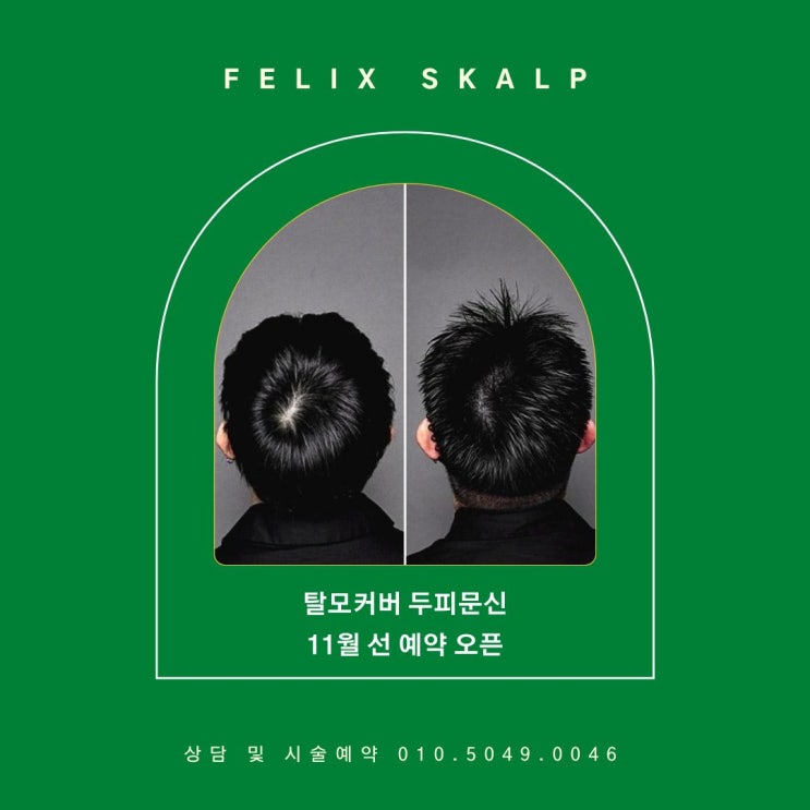  운양동 탈모 고민 많으시다면 꼭 한번 이 글을 읽어보세요~!김포두피문신잘하는곳 필릭스스칼프