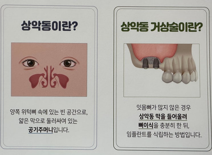  상악동 거상술,18년 경력 전문의가 정리합니다.