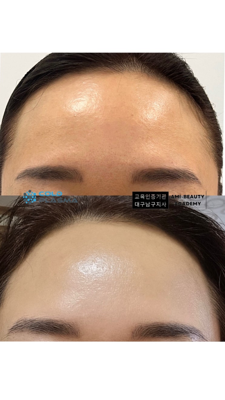  대구 피부관리 꺼진관자 꺼진이마! 이마 볼륨 빵빵 필러 말고 콜드플라즈마! 모공 .물광은 덤입니다!!