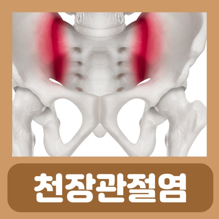 오른쪽 왼쪽 허리 골반 통증 천장관절염 천장관절 증후군