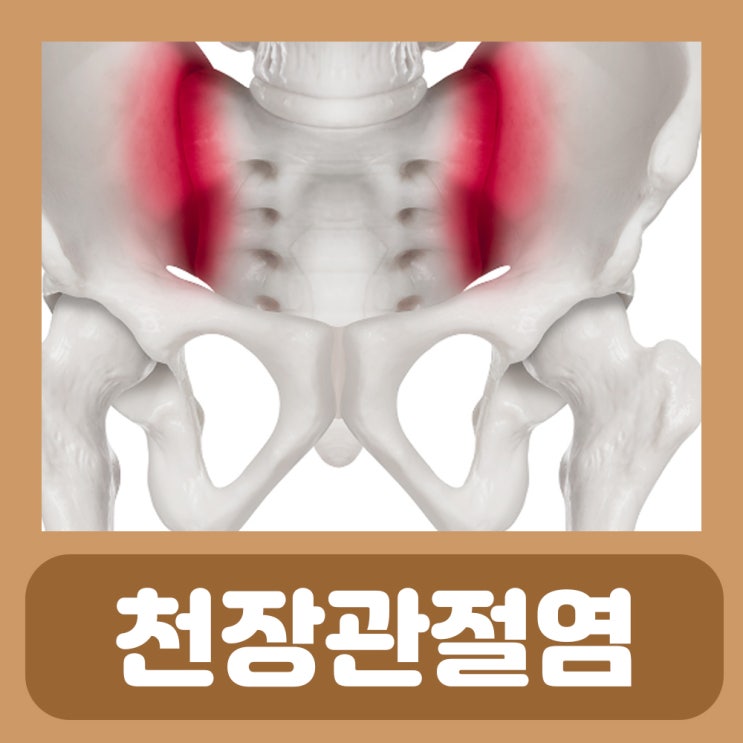  오른쪽 왼쪽 허리 골반 통증 천장관절염 천장관절 증후군