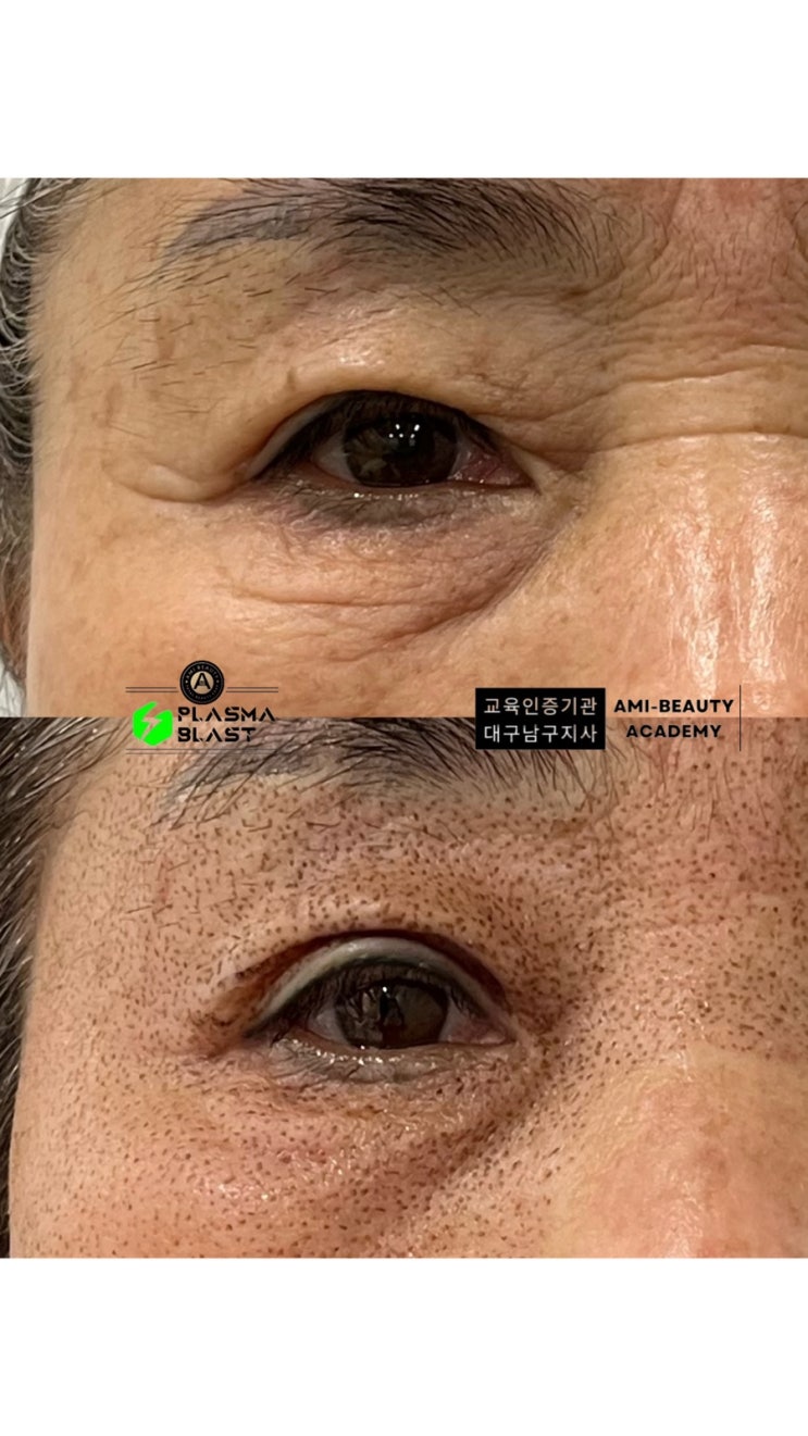  대구 쳐진피부 주름 불독살 마리오네트 고양이주름  거상수술 말고 플라즈마블라스트로 한방에 해결!