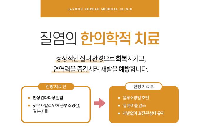  산본질염 재발되는 이유, 치료방법