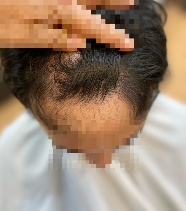  앞머리와정수리남자탈모시술후 부산사상르네시6층미용실/ 김해양산대저화명명지녹산장유용원진해창원마산울산양산진주밀양사천포항구미경남경북남해거제하동
