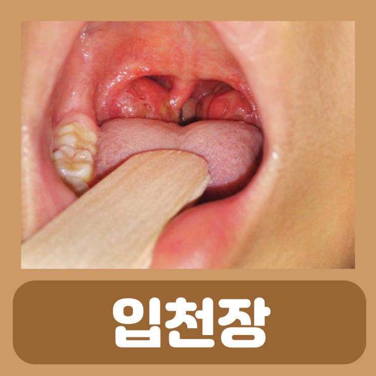  편도 농양 원인 편도궤양 증상