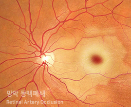 망막출혈(Retinal Hemorrhage)과 망막폐쇄(Retinal Vein Occlusion 또는 Retinal Artery Occlusion)은 서로 다른 상태