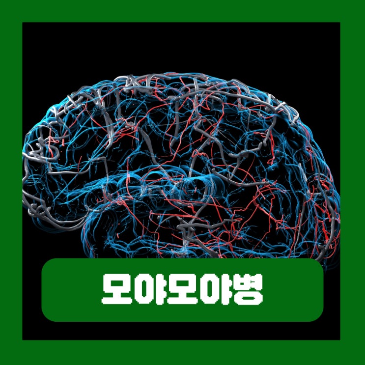 모야모야병 유전 원인 두통 증상 뇌혈관질환 치료방법