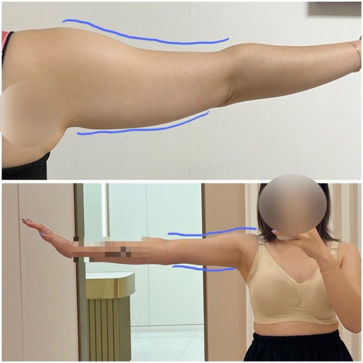  노원 팔뚝 등 부유방 무한람스 지방추출주사 한달차 다이어트 과정, 후기 사진 총 공개