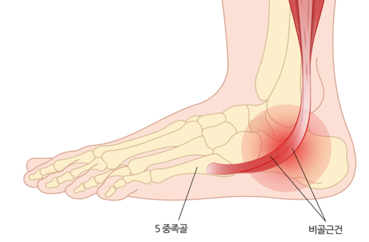  2025년 마라톤 (10km) 대회 참가 준비 중 _ 과유불급(過猶不及) : 건초염의 1차 방해