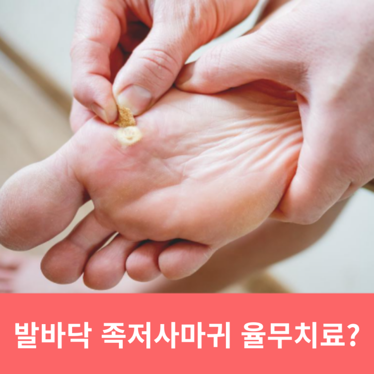  발바닥 족저사마귀 치료 율무가루 냉동치료 가능할까?