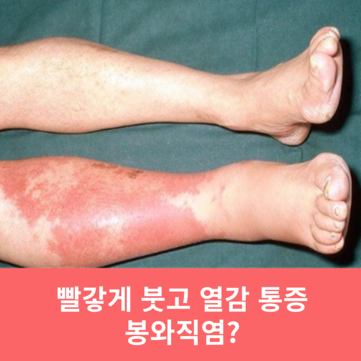  봉와직염(연조직염) 원인 재발 치료 냉찜질 알고해야 증상 완화된다
