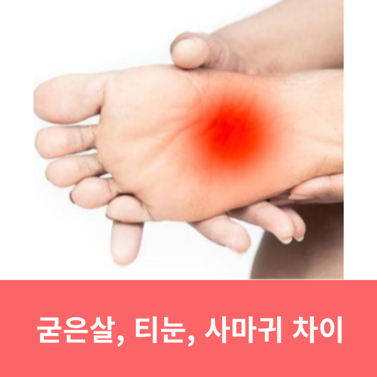  발바닥 굳은살 티눈 사마귀 차이: 티눈 원인 뿌리 제거