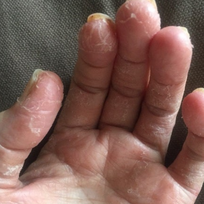  손가락한포진 이렇게 했더니 낫네