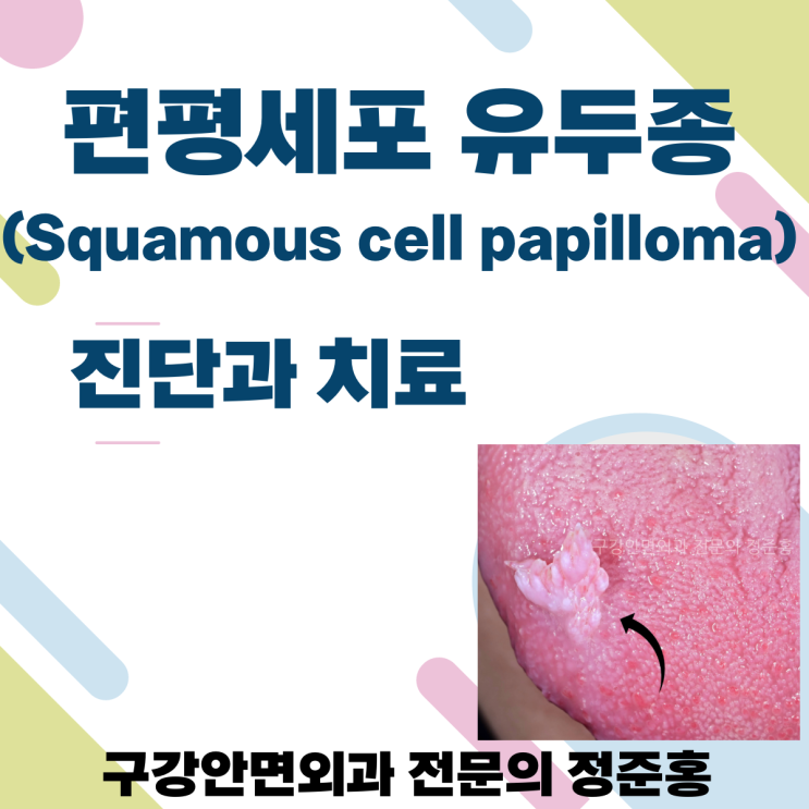  편평세포 유두종 진단과 치료