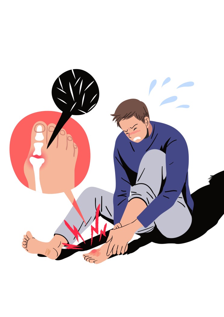  통풍의 초기 증상/ 치료 및 주의할 음식, 평생관리법(의사 작성)