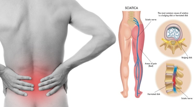  광안리재활) 찌릿찌릿한 허리 , 엉덩이통증 좌골신경통증상 치료 체외충격파