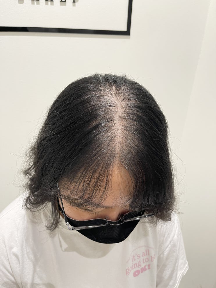  사우동 두피문신 가르마탈모에서 정수리, 원형탈모, 수술자국 커버까지! 드라마틱한 변화를!