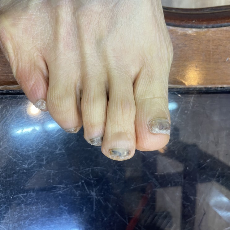  영등포발톱무좀 문제성발관리 온누리체형관리