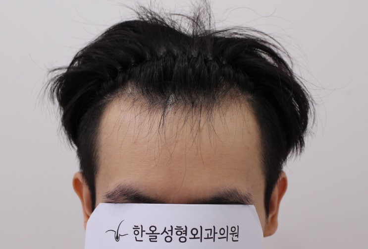  20대 남성 헤어라인 비절개 3000모 2주 경과