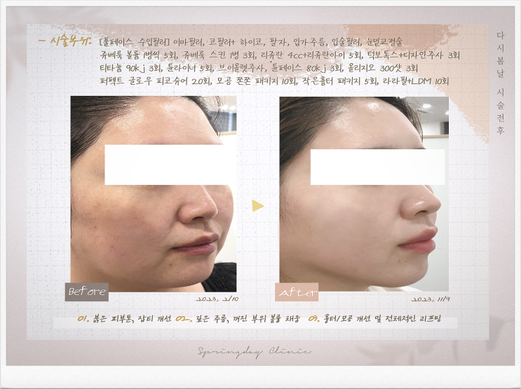  발산역피부과 튠페이스 튠라이너로 탄력 되찾기