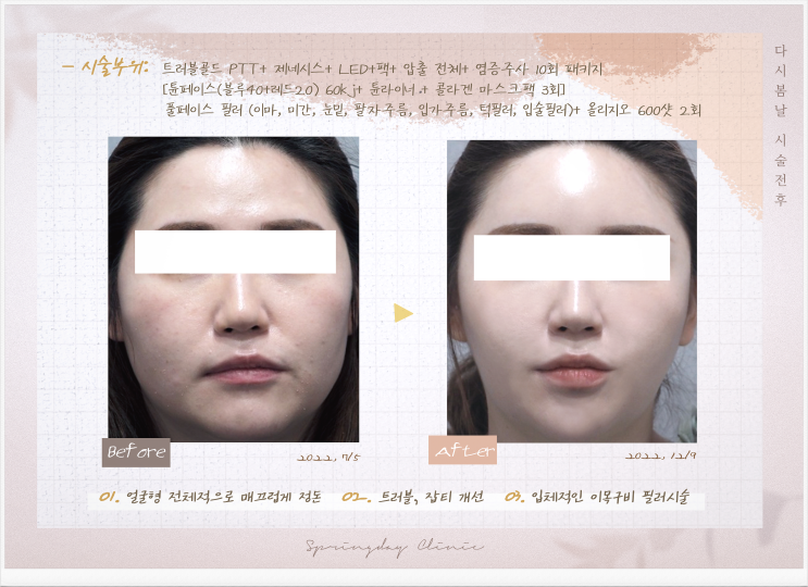  발산피부과 얼굴형 정돈, 동안시술 모음