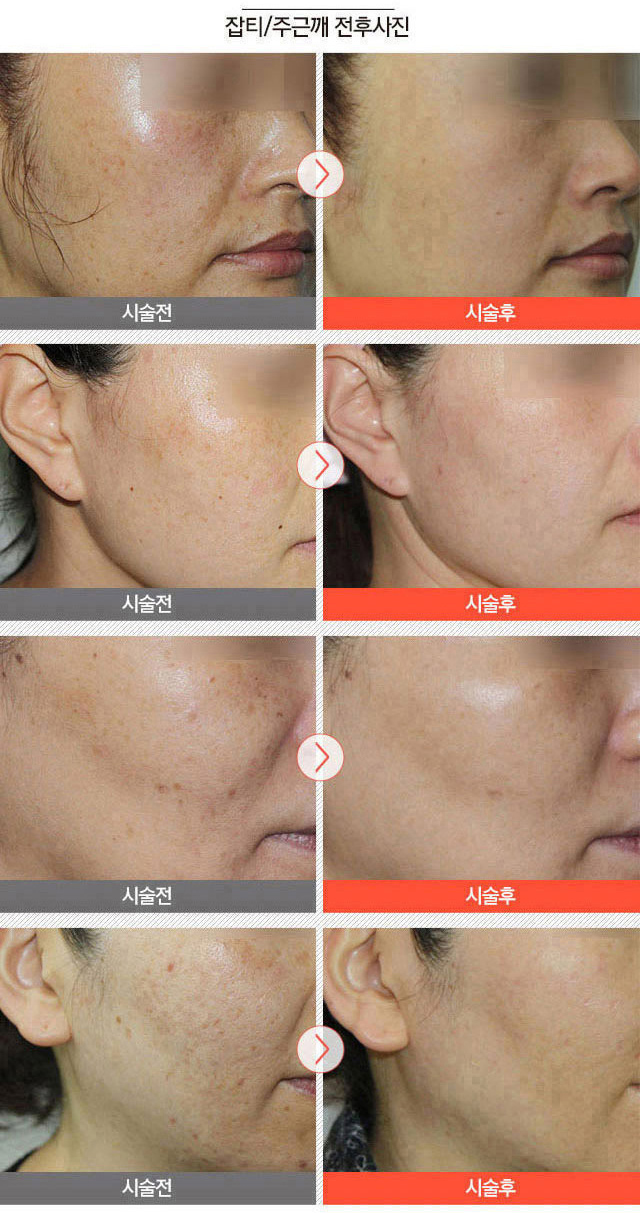  서울대입구역피코레이저토닝, 봄철 피부관리 시~작!