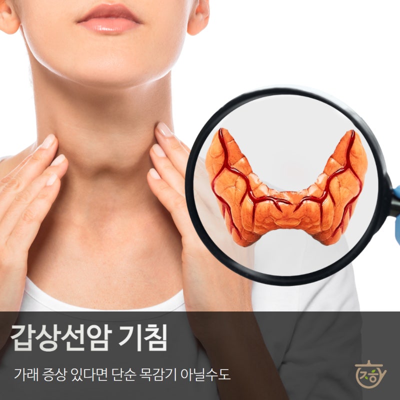 갑상선암 기침 가래 증상 있다면 단순 목감기 아닐수도