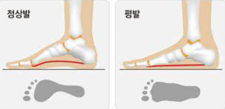  효자동pt 헬스장 / 신시가지pt/ 평발에 좋은 운동 방법!!